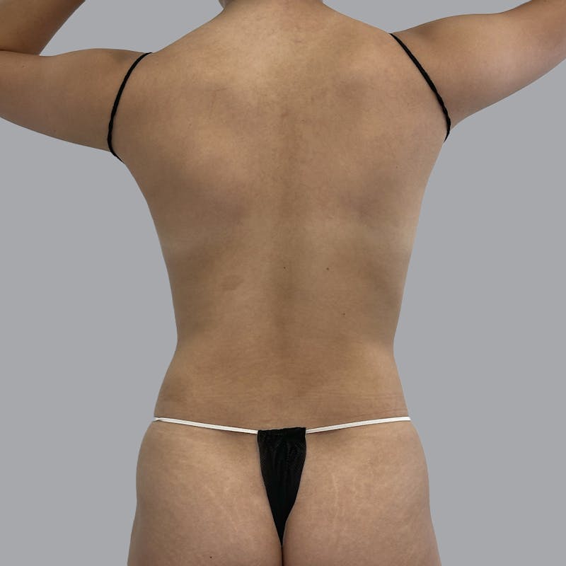 Body Liposuction Before & After Gallery - Patient 209558 - Image 1