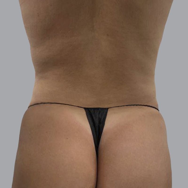 Body Liposuction Before & After Gallery - Patient 551683 - Image 2