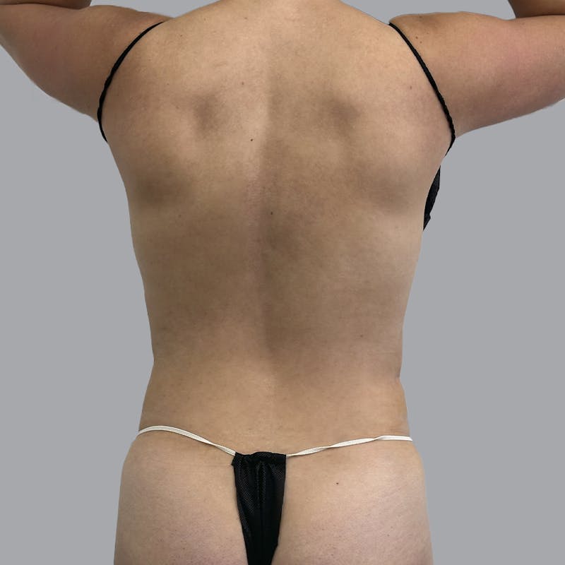 Body Liposuction Before & After Gallery - Patient 268924 - Image 2