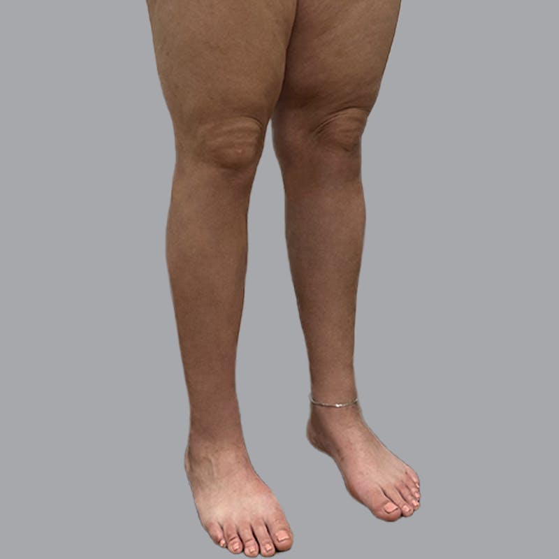 Leg Liposuction Before & After Gallery - Patient 265630 - Image 6