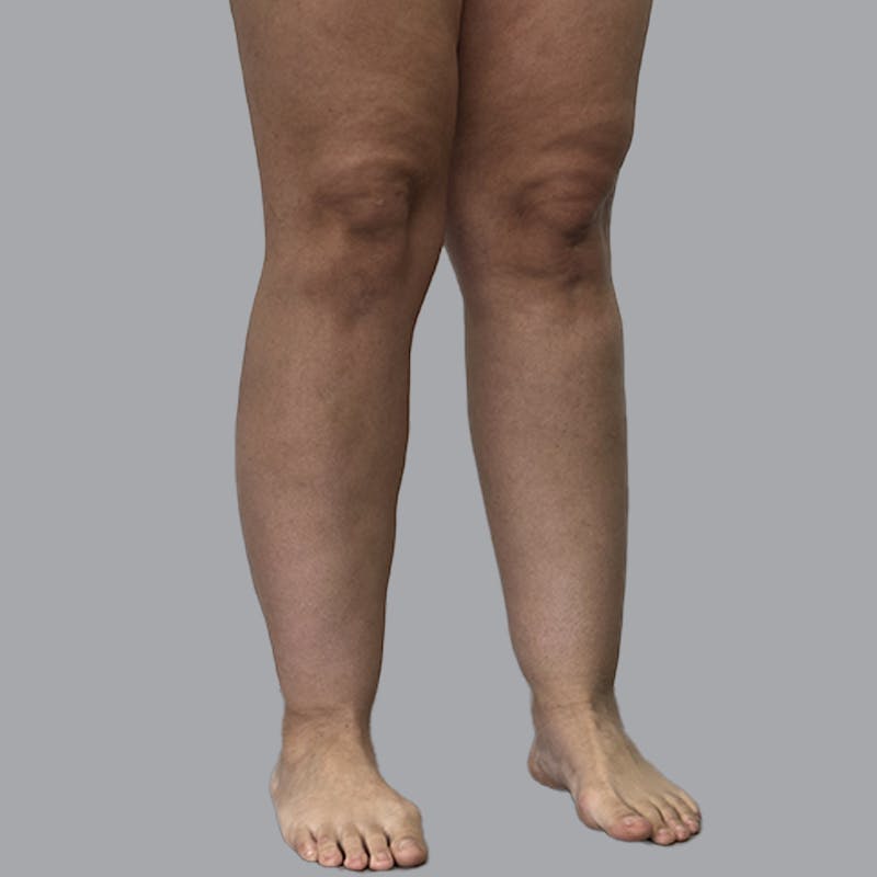 Leg Liposuction Before & After Gallery - Patient 265630 - Image 5