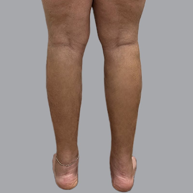 Leg Liposuction Before & After Gallery - Patient 265630 - Image 4