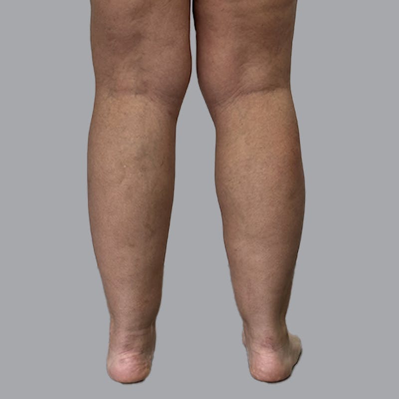 Leg Liposuction Before & After Gallery - Patient 265630 - Image 3