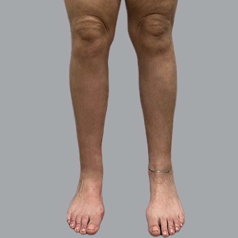 Leg Liposuction Before & After Gallery - Patient 265630 - Image 2