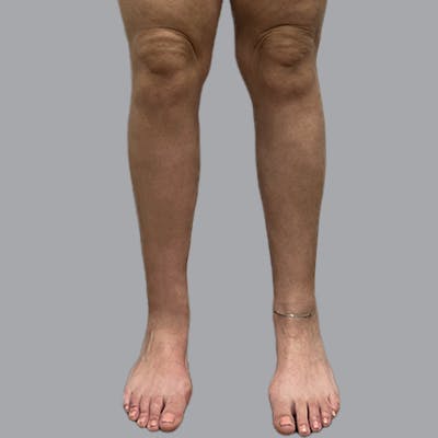 Lipedema Before & After Gallery - Patient 153066 - Image 2