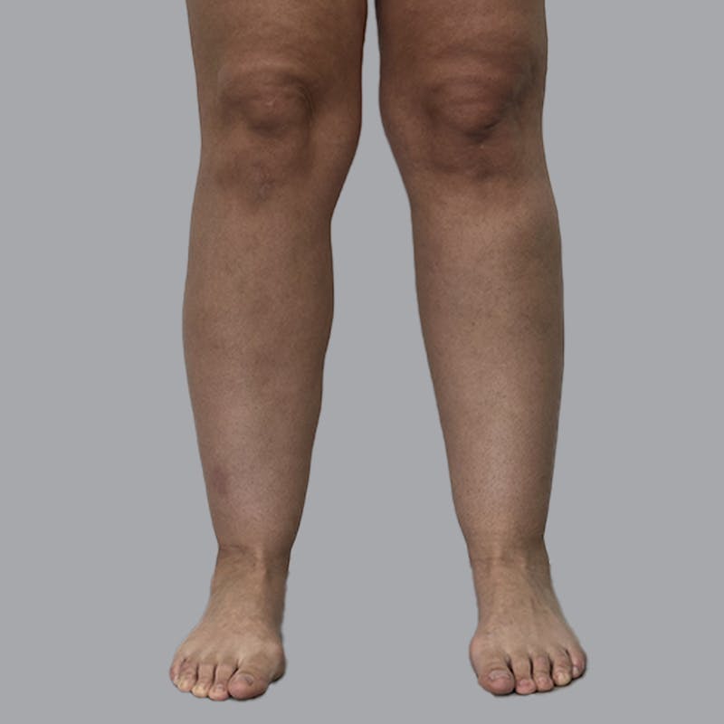 Leg Liposuction Before & After Gallery - Patient 265630 - Image 1