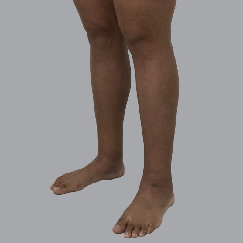 Leg Liposuction Before & After Gallery - Patient 198661 - Image 6