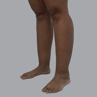 Lipedema Before & After Gallery - Patient 205826 - Image 5