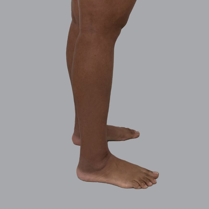 Leg Liposuction Before & After Gallery - Patient 198661 - Image 8