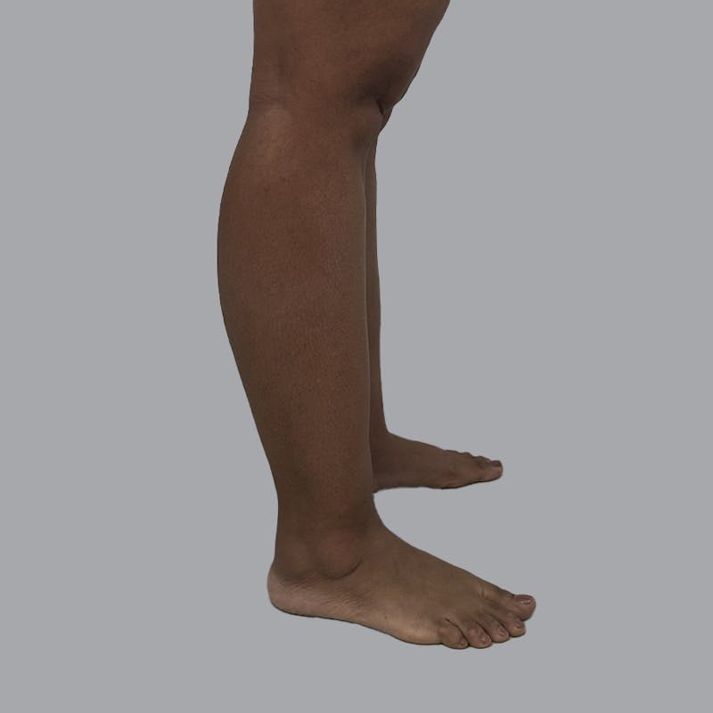 Leg Liposuction Before & After Gallery - Patient 198661 - Image 7