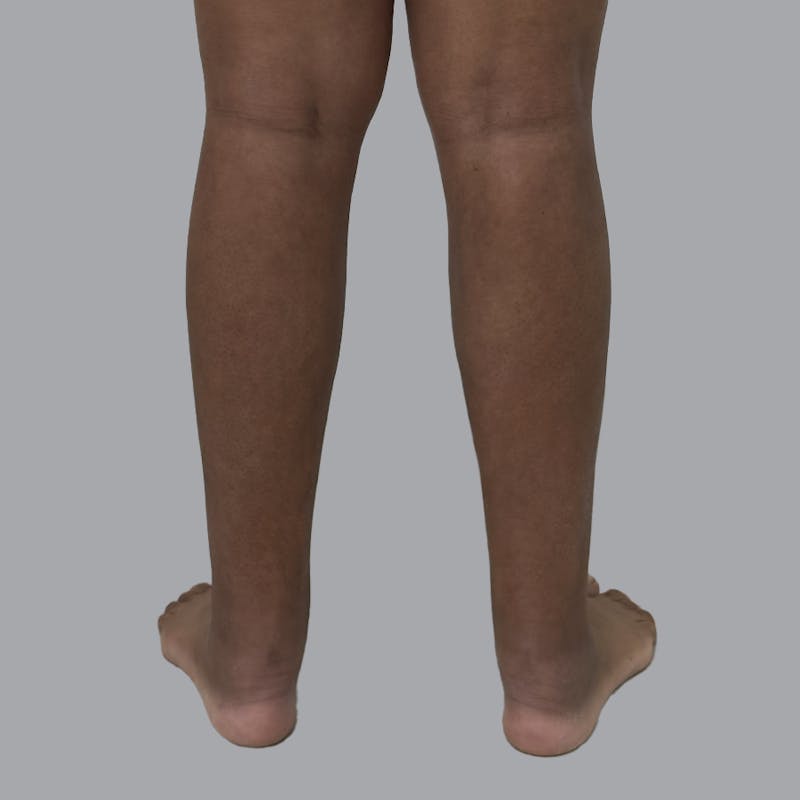 Leg Liposuction Before & After Gallery - Patient 198661 - Image 4