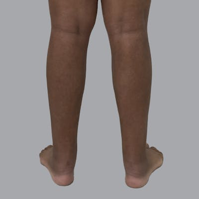 Lipedema Before & After Gallery - Patient 205826 - Image 4
