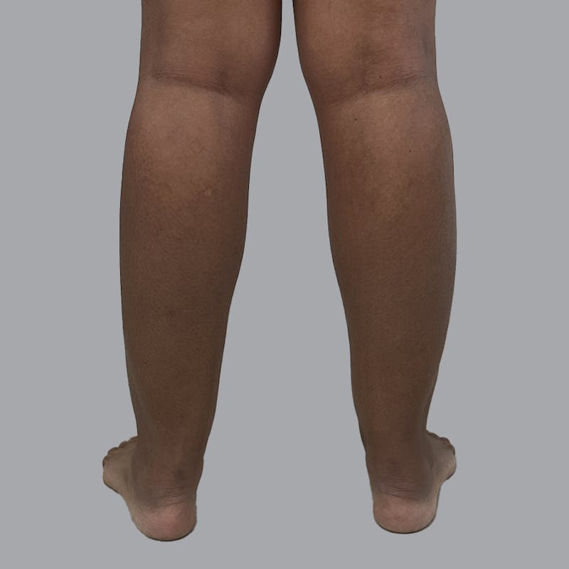 Leg Liposuction Before & After Gallery - Patient 198661 - Image 3