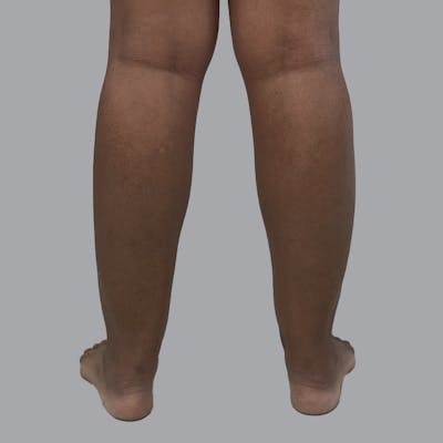 Lipedema Before & After Gallery - Patient 205826 - Image 3