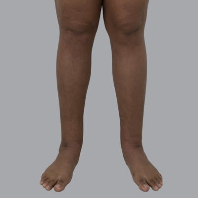 Lipedema Before & After Gallery - Patient 205826 - Image 2