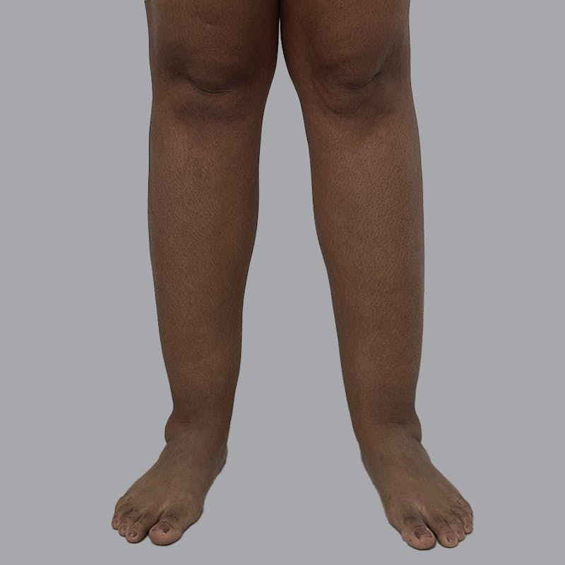 Leg Liposuction Before & After Gallery - Patient 198661 - Image 1