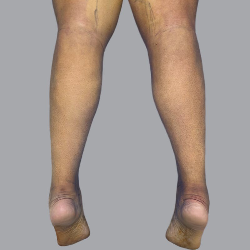 Leg Liposuction Before & After Gallery - Patient 224645 - Image 2