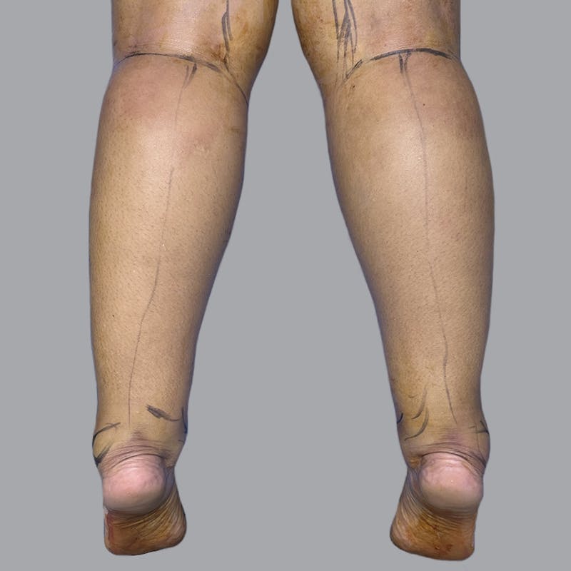 Leg Liposuction Before & After Gallery - Patient 224645 - Image 1