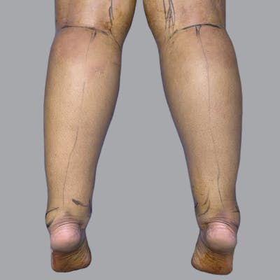 Lipedema Before & After Gallery - Patient 367774 - Image 1
