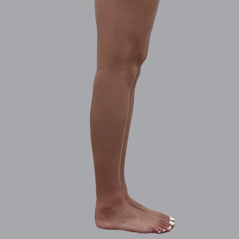 Leg Liposuction Before & After Gallery - Patient 317617 - Image 4