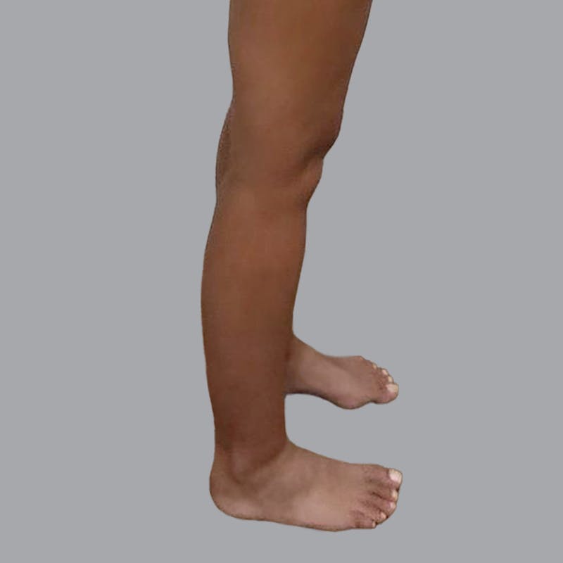Leg Liposuction Before & After Gallery - Patient 317617 - Image 3
