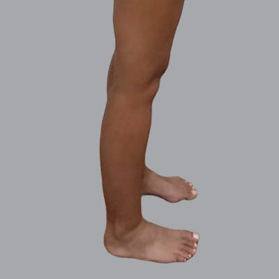 Lipedema Before & After Gallery - Patient 228661 - Image 3