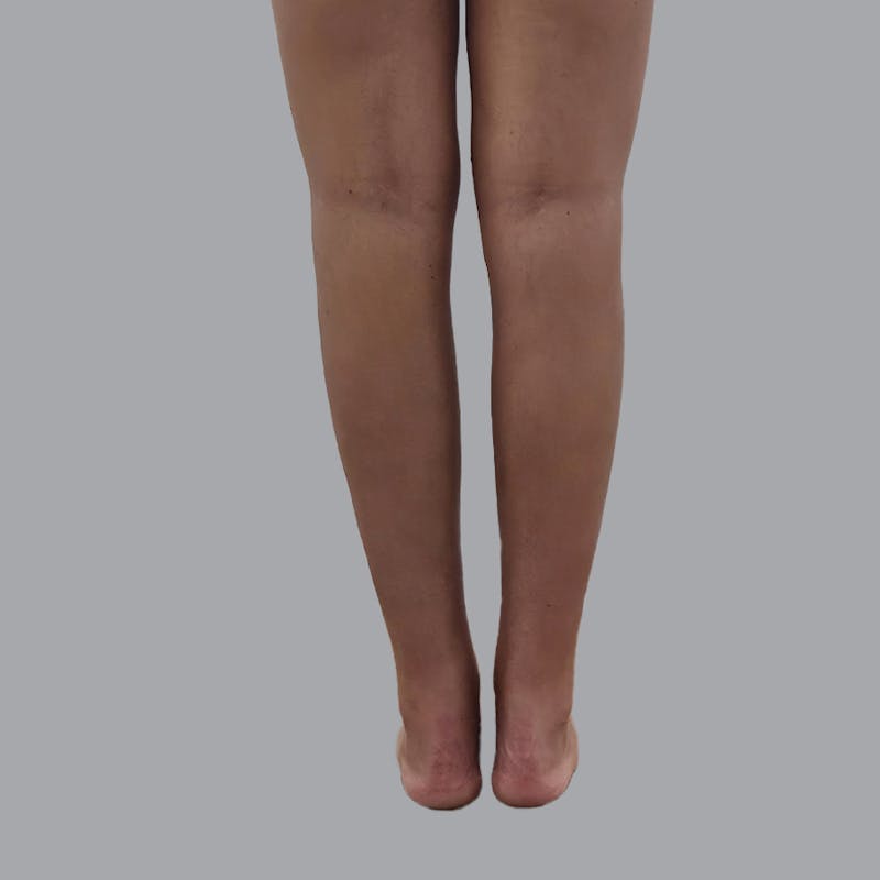 Leg Liposuction Before & After Gallery - Patient 317617 - Image 2