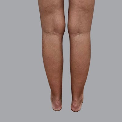 Lipedema Before & After Gallery - Patient 228661 - Image 1