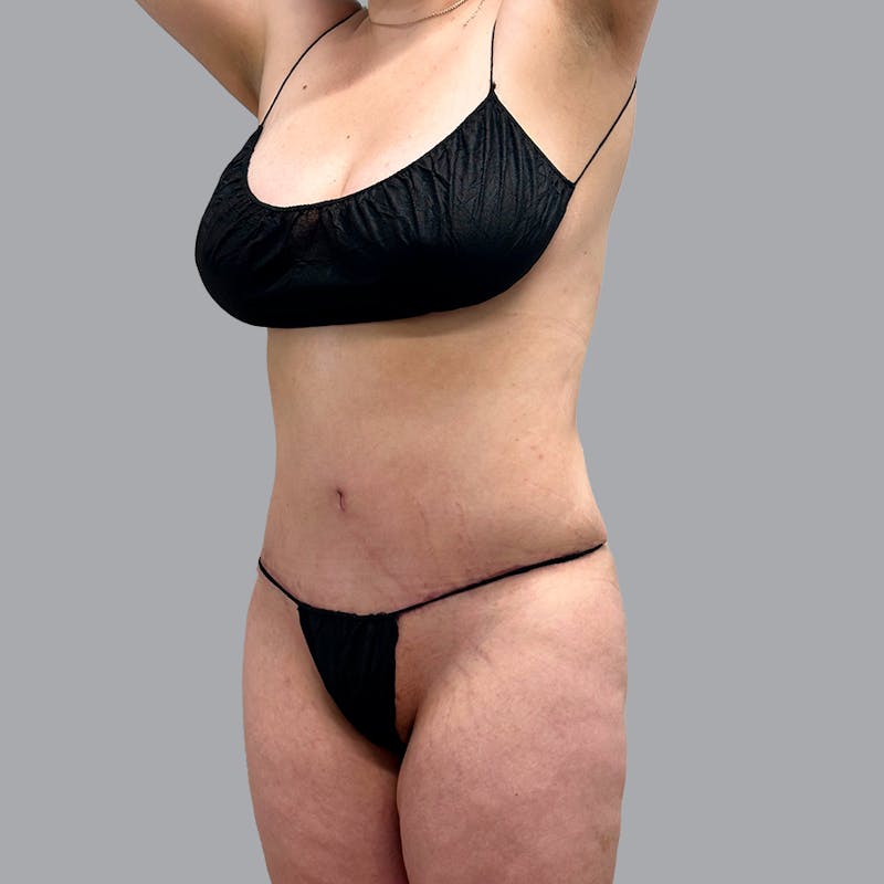 Abdominoplasty Before & After Gallery - Patient 947183 - Image 4