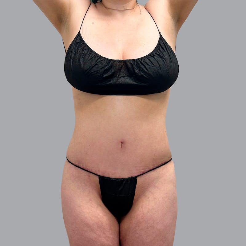 Abdominoplasty Before & After Gallery - Patient 947183 - Image 2