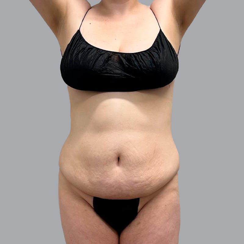 Abdominoplasty Before & After Gallery - Patient 947183 - Image 1