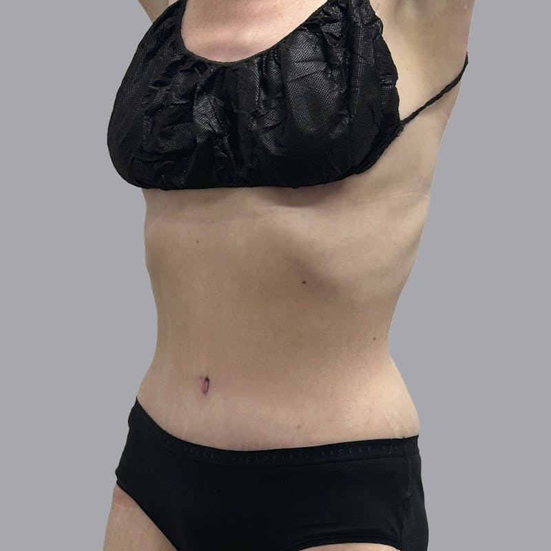 Abdominoplasty Before & After Gallery - Patient 388923 - Image 4