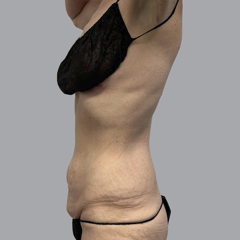 Abdominoplasty Before & After Gallery - Patient 388923 - Image 5