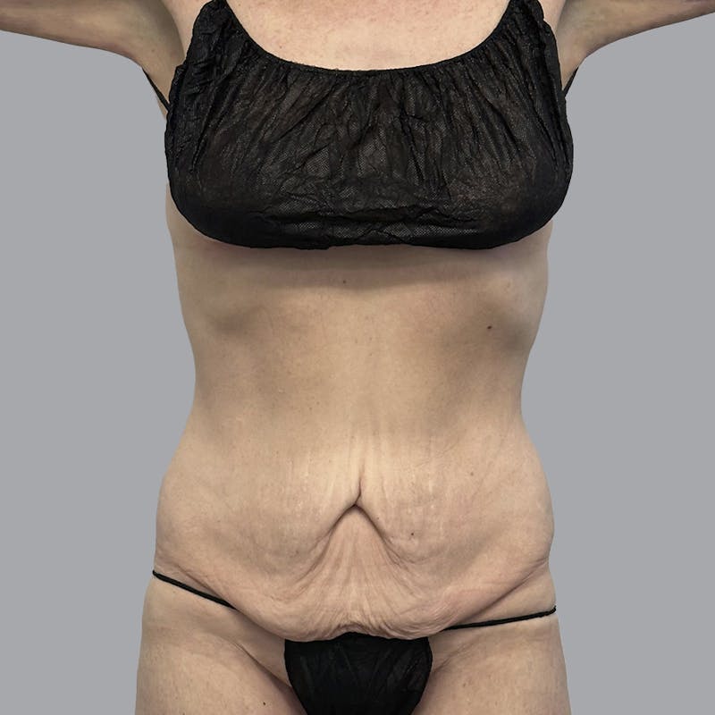 Abdominoplasty Before & After Gallery - Patient 388923 - Image 1