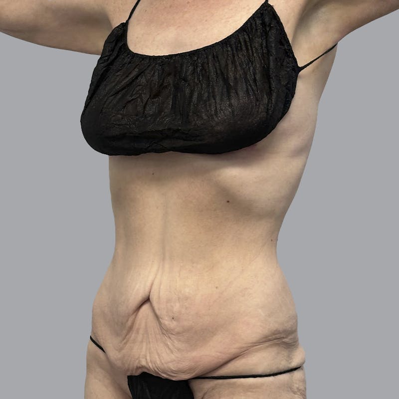 Abdominoplasty Before & After Gallery - Patient 388923 - Image 3