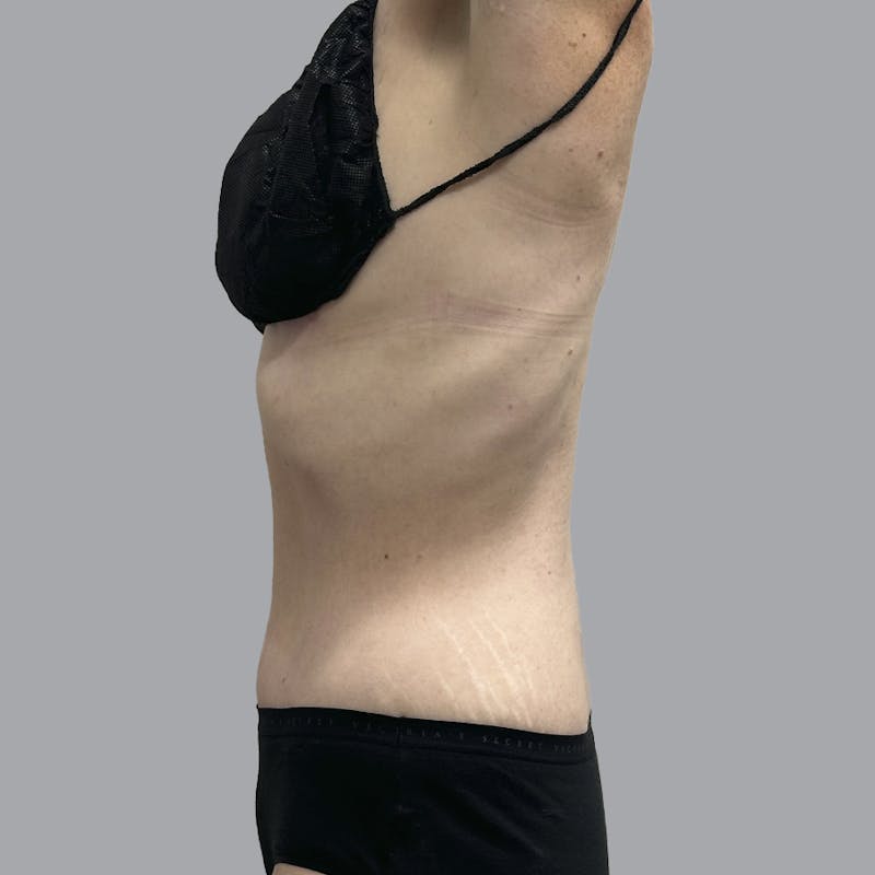 Abdominoplasty Before & After Gallery - Patient 388923 - Image 6