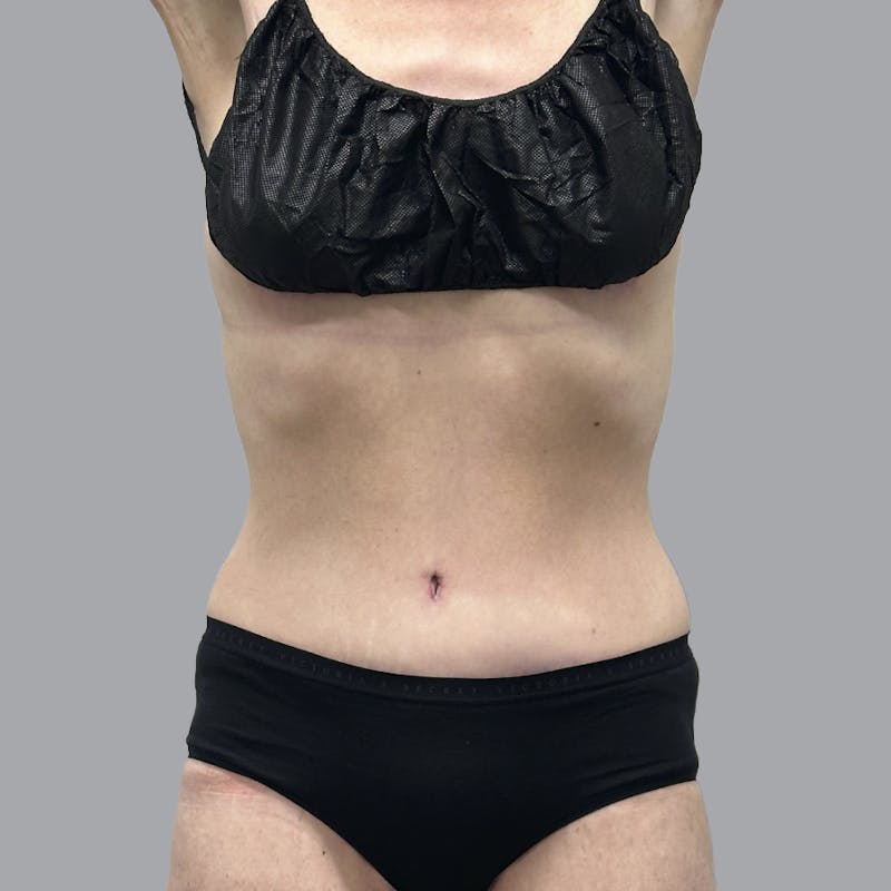 Abdominoplasty Before & After Gallery - Patient 388923 - Image 2