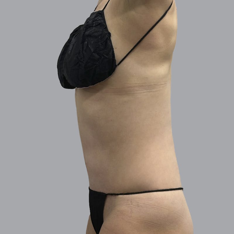 Abdominoplasty Before & After Gallery - Patient 419516 - Image 4