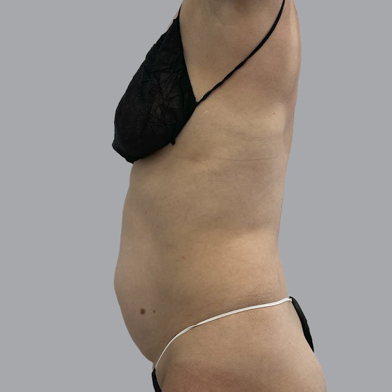 Abdominoplasty Before & After Gallery - Patient 419516 - Image 3