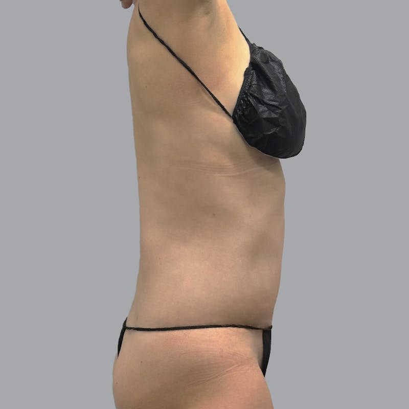 Abdominoplasty Before & After Gallery - Patient 419516 - Image 6