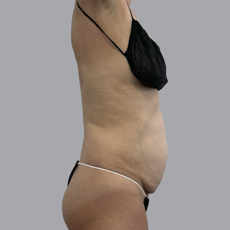 Abdominoplasty Before & After Gallery - Patient 419516 - Image 5