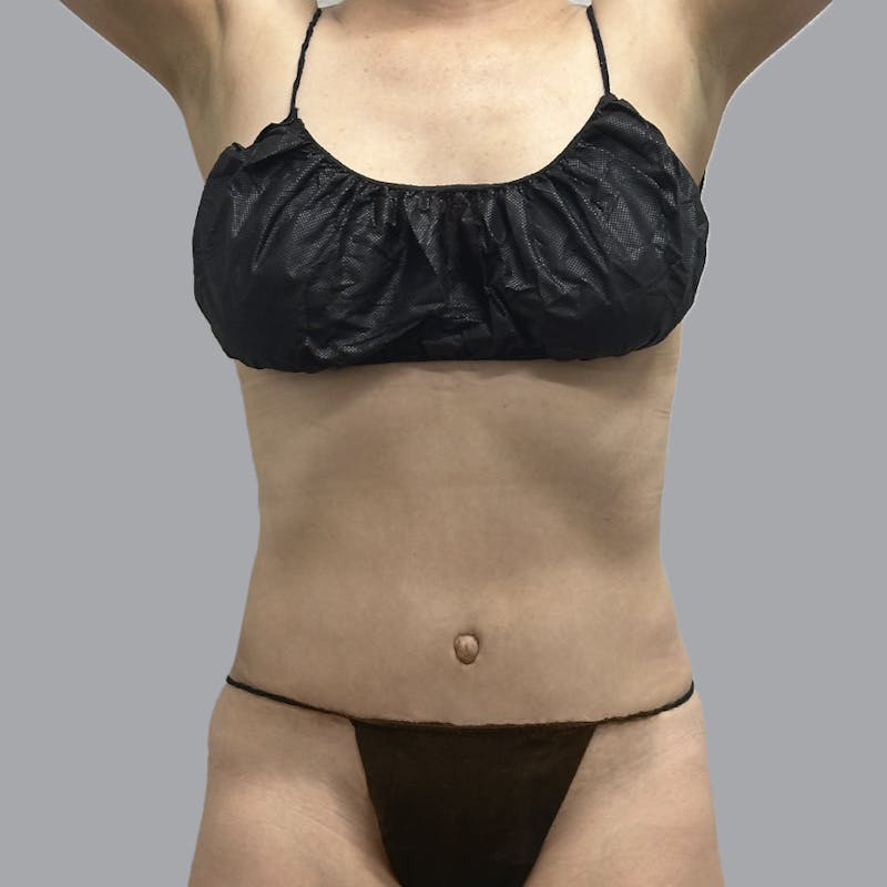 Abdominoplasty Before & After Gallery - Patient 419516 - Image 2