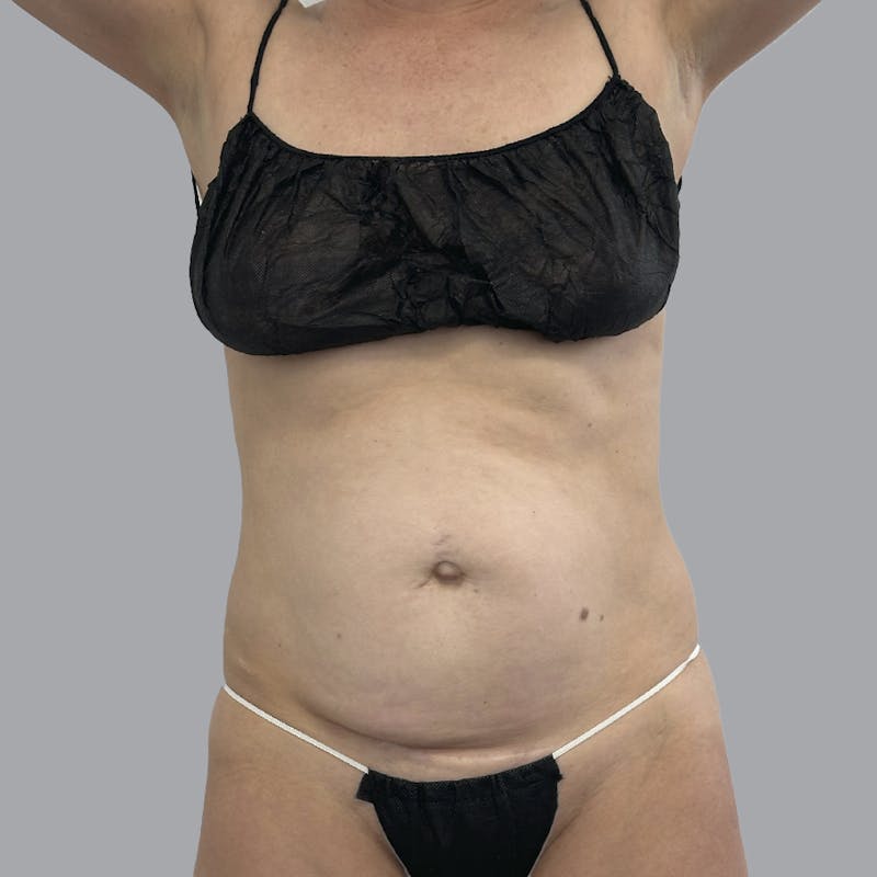 Abdominoplasty Before & After Gallery - Patient 419516 - Image 1