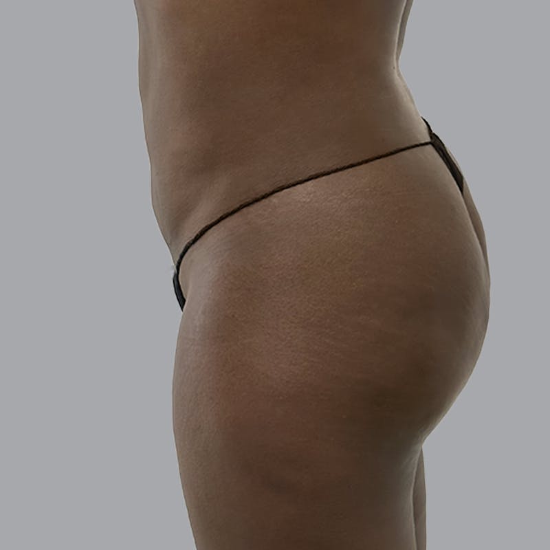 Brazilian Butt Lift and Hip Dip Before & After Gallery - Patient 796277 - Image 4