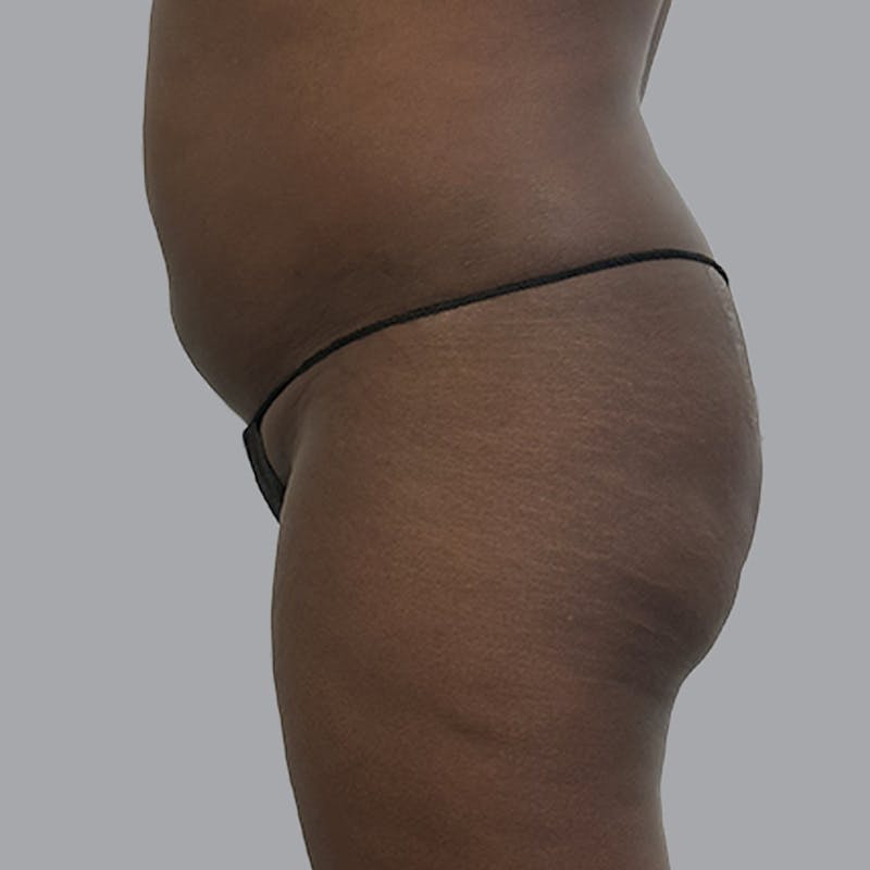Brazilian Butt Lift and Hip Dip Before & After Gallery - Patient 796277 - Image 3