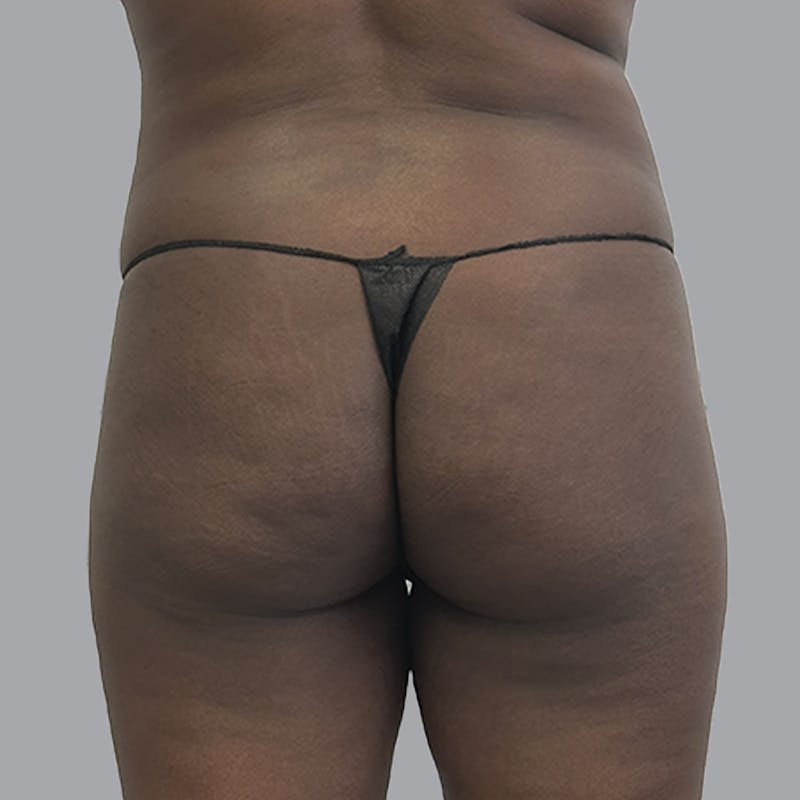 Brazilian Butt Lift and Hip Dip Before & After Gallery - Patient 796277 - Image 1