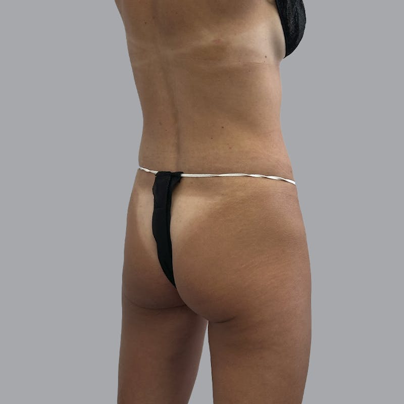 Brazilian Butt Lift and Hip Dip Before & After Gallery - Patient 366805 - Image 3