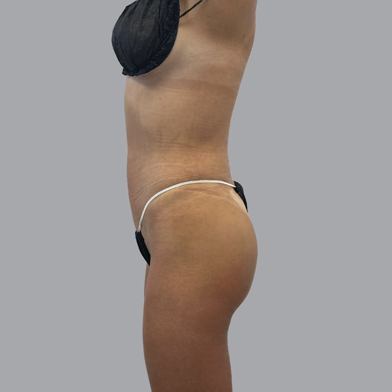 Brazilian Butt Lift and Hip Dip Before & After Gallery - Patient 366805 - Image 6