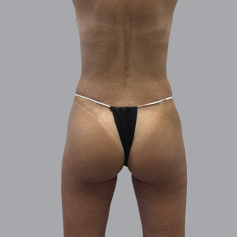 Brazilian Butt Lift and Hip Dip Before & After Gallery - Patient 366805 - Image 2