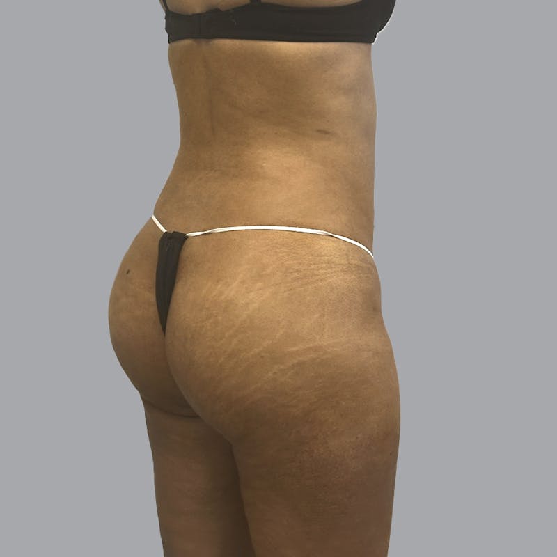 Brazilian Butt Lift and Hip Dip Before & After Gallery - Patient 291392 - Image 4